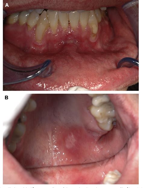 Figure 1 From Oral Syphilis A Series Of 5 Cases Semantic Scholar