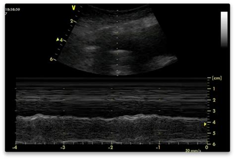 A pleural effusion may be malignant (caused by cancer) or nonmalignant (caused by a condition that is not cancer). Pleural Effusion