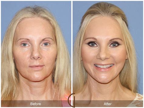 Five Tips To Reduce Swelling After Facelift Surgery