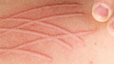 Skin Scratch Marks