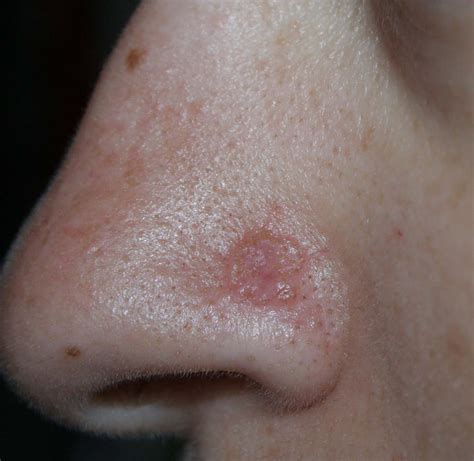 Top 104 Images Photos Of Sun Blisters On Lips Superb