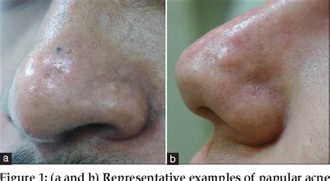 Papular Acne Scars Of The Nose And Chin An Under Recognised Variant Of Acne Scarring Semantic