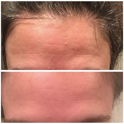 This Painless Derma Roller Is Producing Incredible Before And After