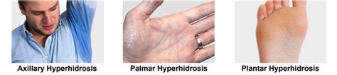 Hyperhidrosis Therapy Orlando Associates In Dermatology