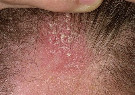 Whats Causing Seborrheic Dermatitis On Scalp All Rash