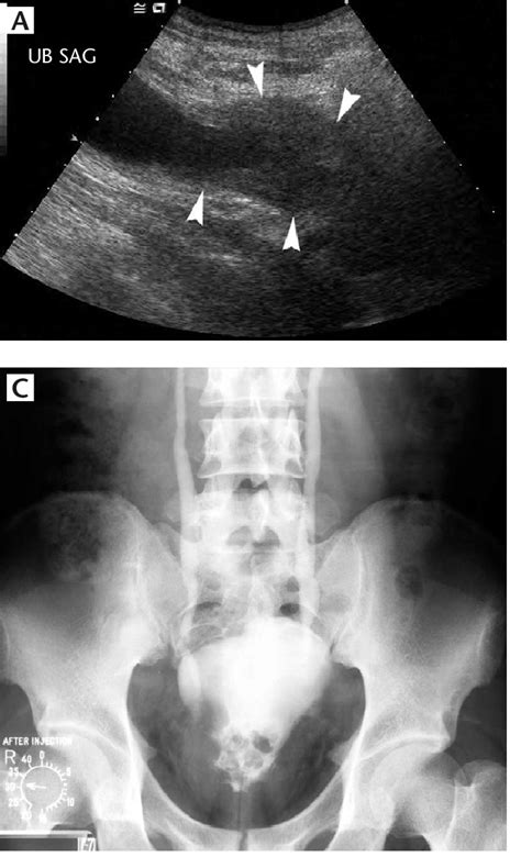 Cystitis Cystica In A 34 Year Old Man A Longitudinal Ultrasound Of