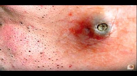 Best Blackhead Ever Viral On The Web Now