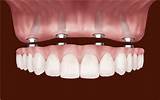 Images of Can Dental Implants Be Done In A Day