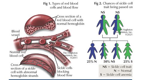 Sickle Cell Trait In Sports Hughston Clinic