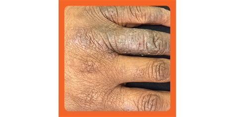 Eczema Rash On Black Skin