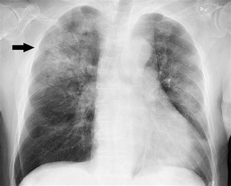 3 Perbedaan Antara Pneumonia Dan Bronkitis Blog Artikelkeren