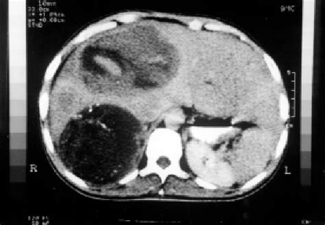 Aspecto Tomográfico Do Carcinoma Hepatocelular Com Múltiplas Lesões