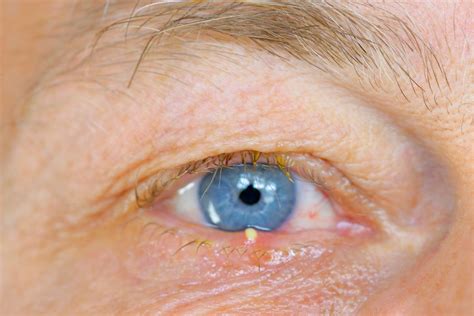 Eyelid Bumps How To Identify Styes Milia And Pimples Allure Free