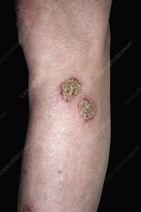 Infected Discoid Eczema Stock Image C0515150 Science Photo Library
