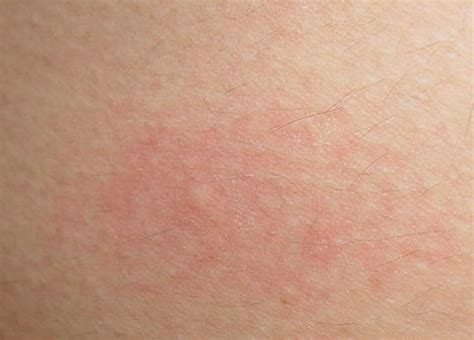 Pictures Of Skin Rashes Skin Rashes Kids Causes And Methods Of