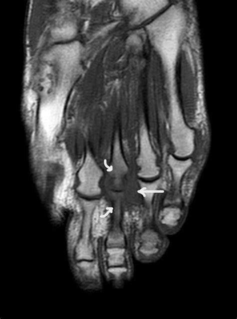 Cureus Diagnostic And Therapeutic Challenge Of Metatarsalgia In A