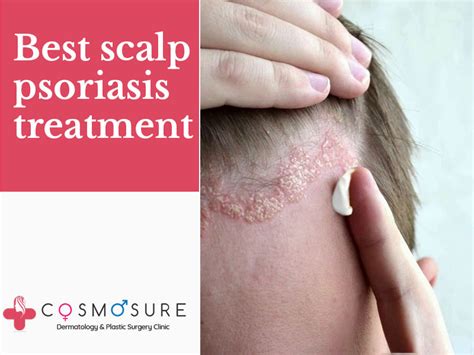 Best Scalp Psoriasis Treatment Cosmosure Clinic