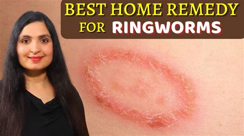 How To Deal With Ringworm Naturally Quickest Way To Get Rid Of