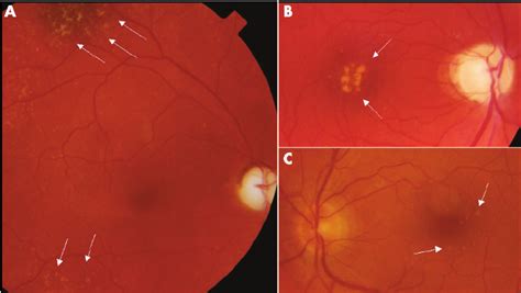 Fundoscopy Findings A Right Fundus Of The Proband Iv 4 Showing