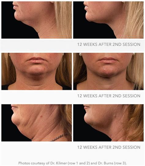 Coolsculpting Results With Coolmini Chin Coolsculpting Pinterest