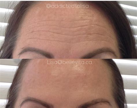 Forehead Wrinkles Before And After Botox Revive Laser And Skin Clinic