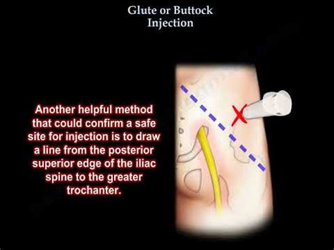 Buttock Intramuscular Injection Technique Video MEDtube Net