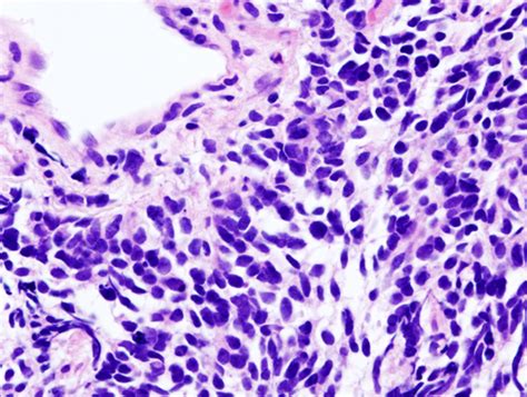 Benign Mesothelioma Lung Cancer Small Cell Lung Carcinoma Metastasis