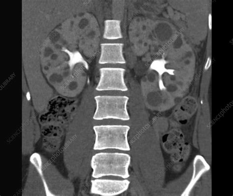 Polycystic Kidneys Ct Scan Stock Image C0388606 Science Photo