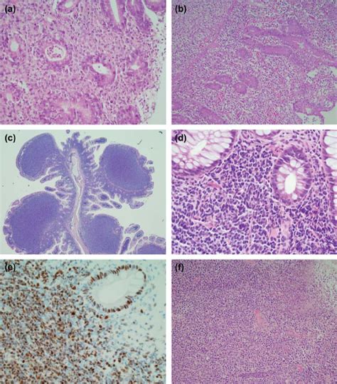 Histology Of Rare Gi Lymphomas A Eatl Type I Of The Duodenum B