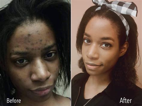 Treating Acne Scars And Hyperpigmentation On Brown Skin Sisterlocked