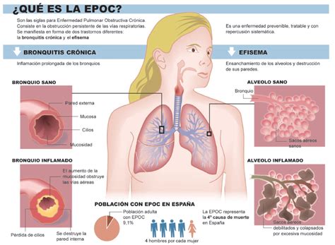La Bronquitis Escuelapedia Recursos Educativosescuelapedia Recursos Educativos