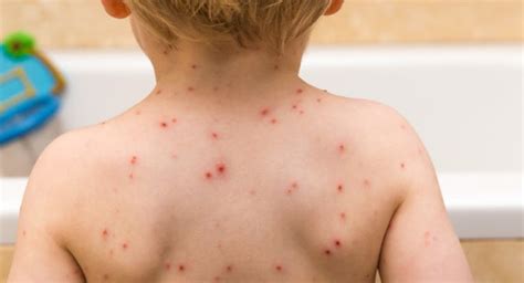 Measles Causes Symptoms Treatment Complications And Prevention