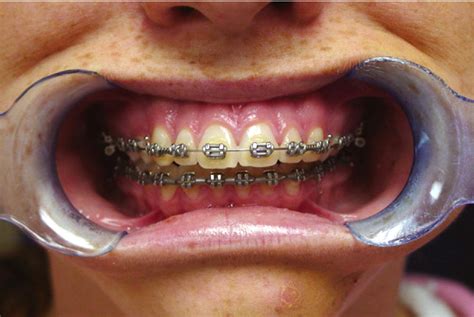 Efficient Surgical Management Of Mandibular Asymmetry Journal Of Oral
