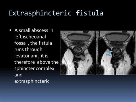 ppt mri imaging of perianal fistula powerpoint presentation free download id 2986971