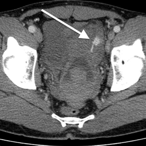 Axial Ct Scan Demonstrating Active Extravasation Within The Pelvis