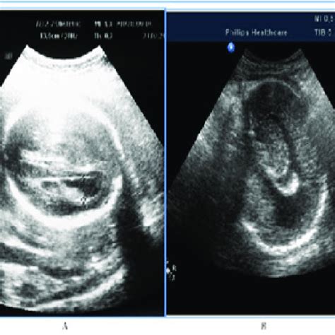 Mild And Moderate Fetal Ventriculomegaly 3cases Download Scientific