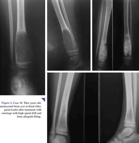Figure 2 From Treatment Of Aneurysmal Bone Cysts With Allograft