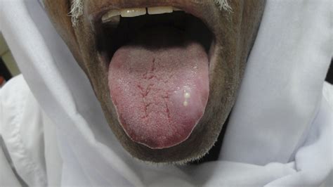 Photograph Showing The Tongue Swelling Download Scientific Diagram