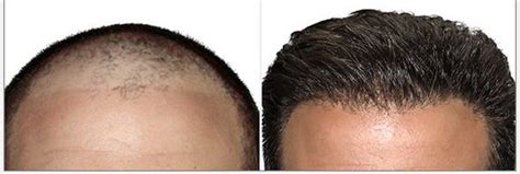 People Who Are Suffering From Severe Hair Loss Or Baldness Are Able To