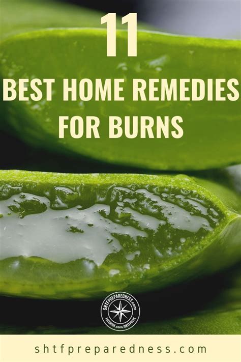 11 Best Home Remedies For Burns Recipe Home Remedies For Burns