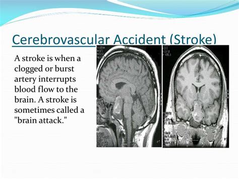 Ppt Cerebrovascular Accident Stroke Powerpoint Presentation Id