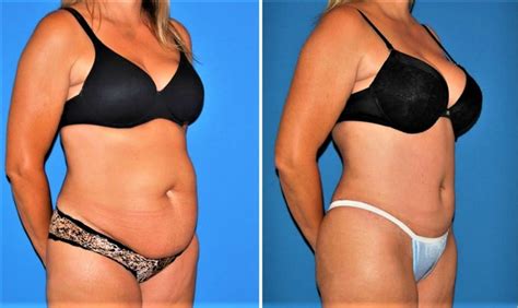 Abdominoplasty Surgery Recovery Before And After Risks