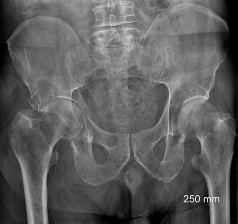 Hip Fractures In The Elderly A Surprising Finding Orthobuzz