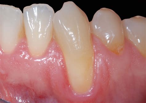 Cura Della Parodontite Studi Dentistici Lampis Istadent