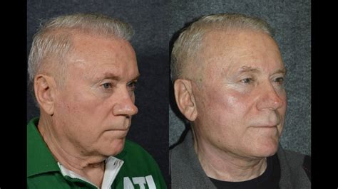 Facelift For Men Before And After Male Plastic Surgery With Dr Jacono