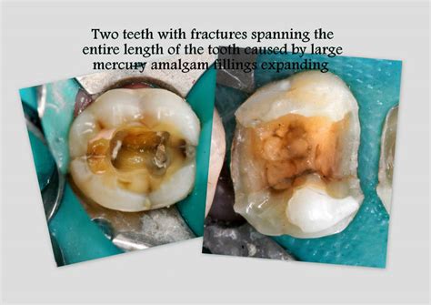 In most cases it's possible to prevent the need for further root canal. What You Need to Know About Root Canals - Homeopathic ...