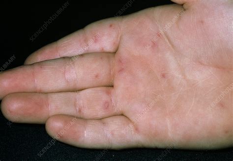 Lesions On Hand Due To Hand Foot And Mouth Disease Stock Image M170
