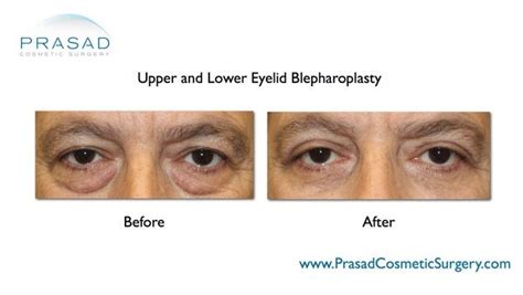 Are the prices different for blepharoplasty on the upper eyelids vs. Eye bag surgery | Lower eyelid surgery | Puffy eyes - NY