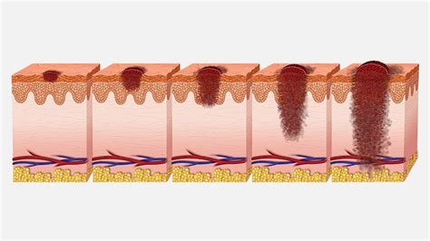 Stages Of Melanoma Skin Cancer