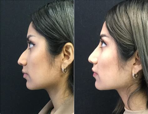 Non Surgical Rhinoplasty Before And After Photos Fairfax Ng